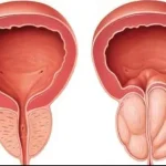 High-Intensity Focused Ultrasound for Prostate Cancer Unveiled by an Expert