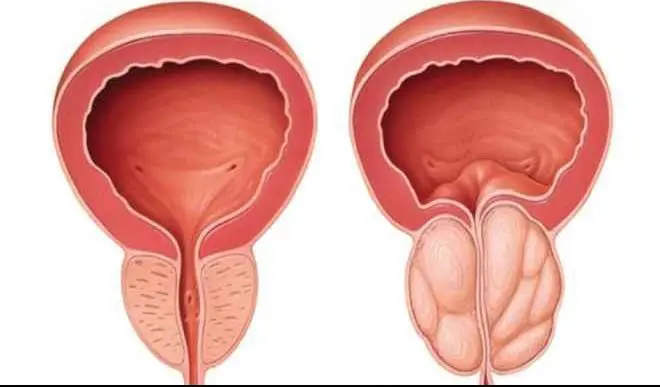 High-Intensity Focused Ultrasound for Prostate Cancer Unveiled by an Expert